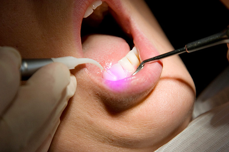 Laserbehandlung-Rastatt-Zahnarzt